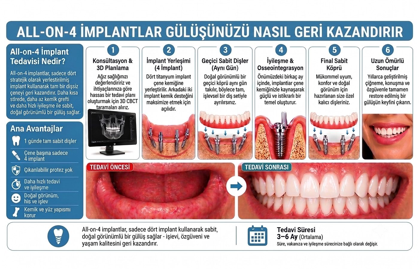 all-on-4-implant-detay