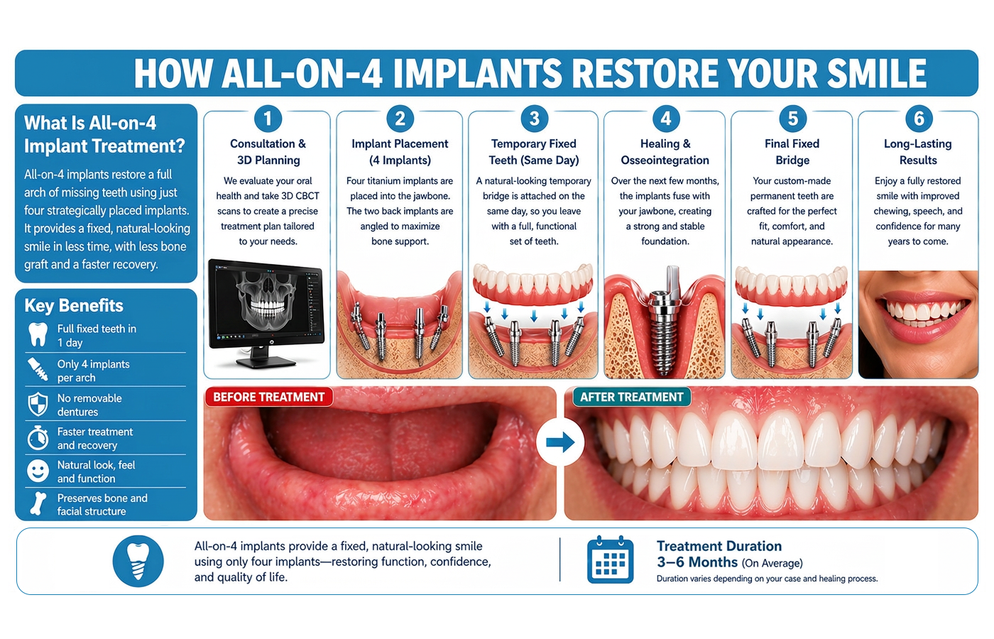 all-on-4-implants