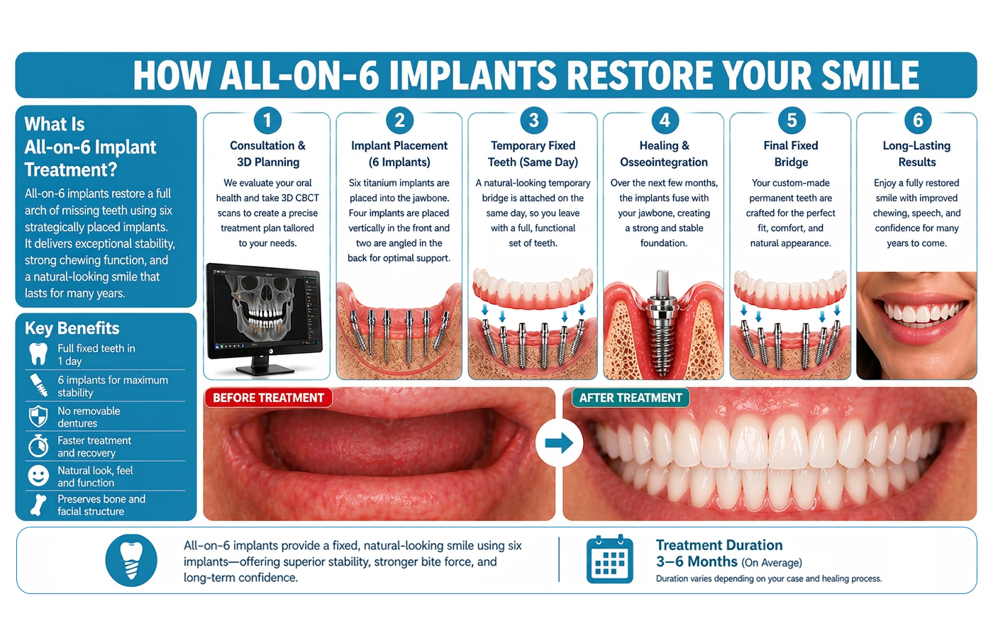 all-on-6-implants