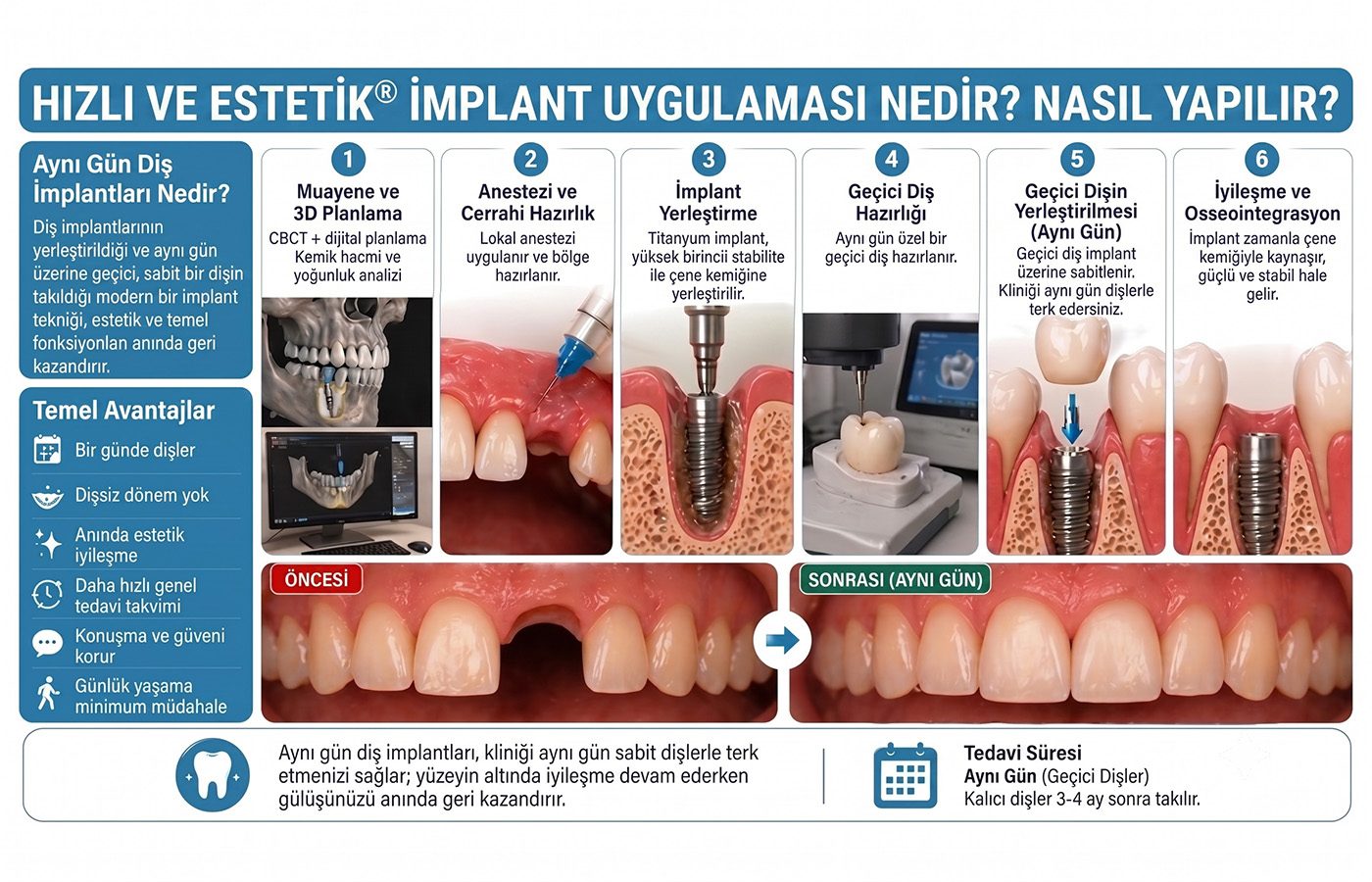 ayni-gun-implant-tedavisi-detay