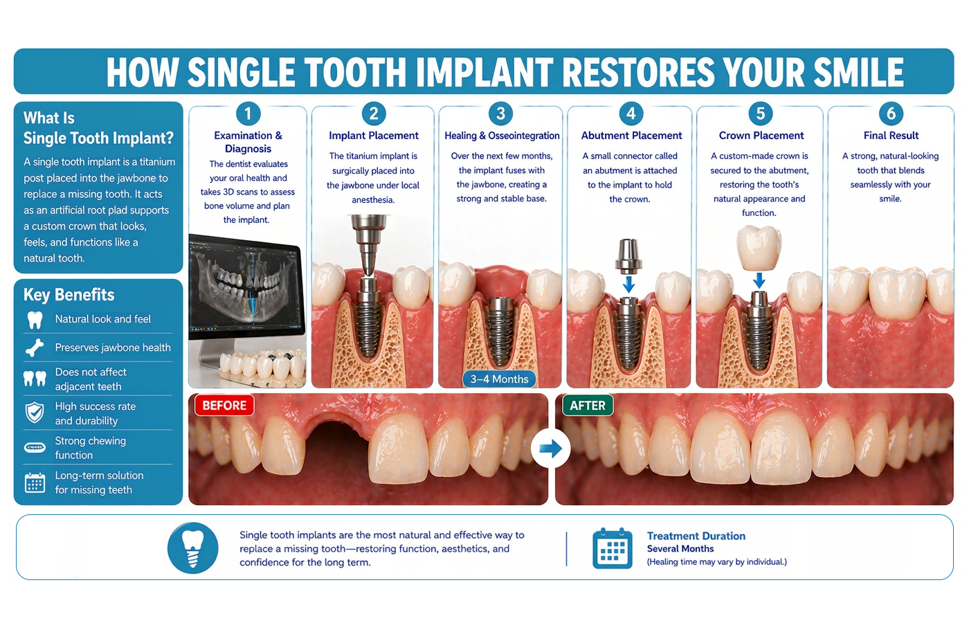 single-tooth-implant